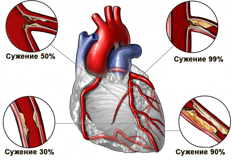 Атеросклероз сосудов сердца