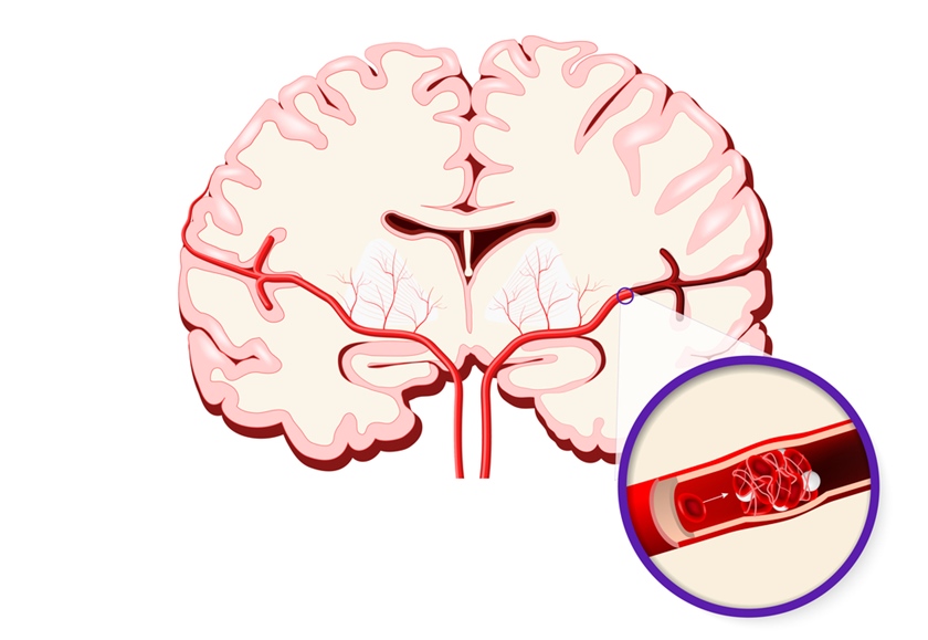 Атеросклероз сосудов головного мозга