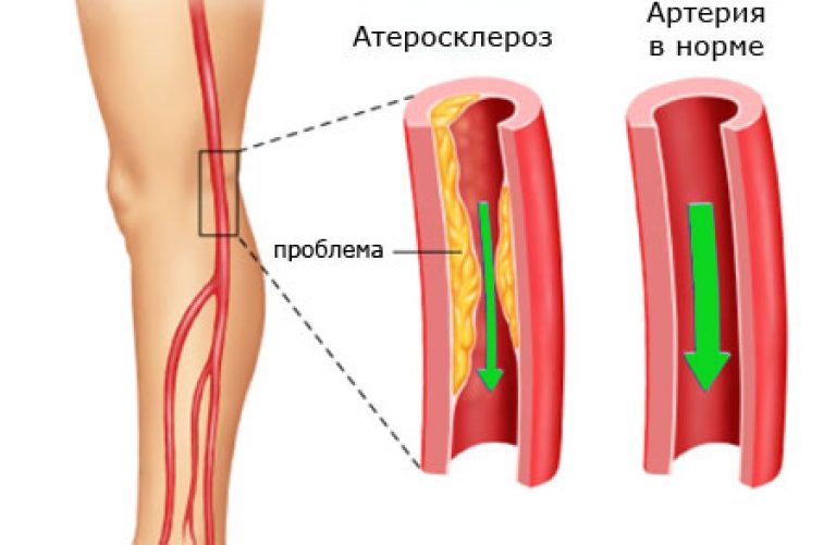 Атеросклероз сосудов нижних конечностей