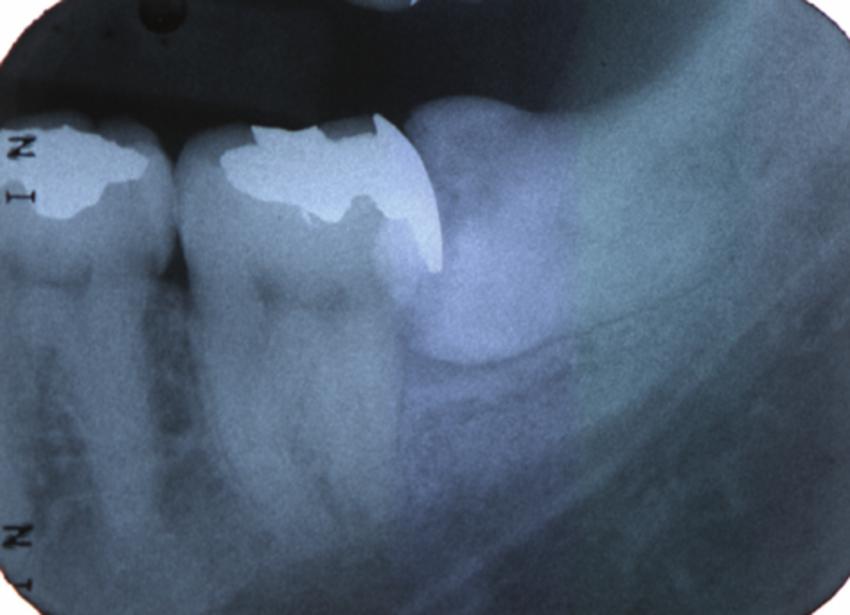перикоронарит стоматология