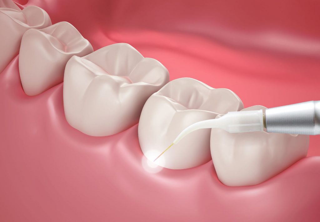 Лазер в стоматологии: показания к применению, противопоказания, отзывы