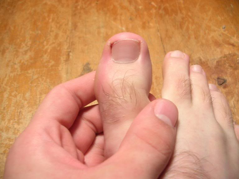 Вросший ноготь на большом пальце ноги