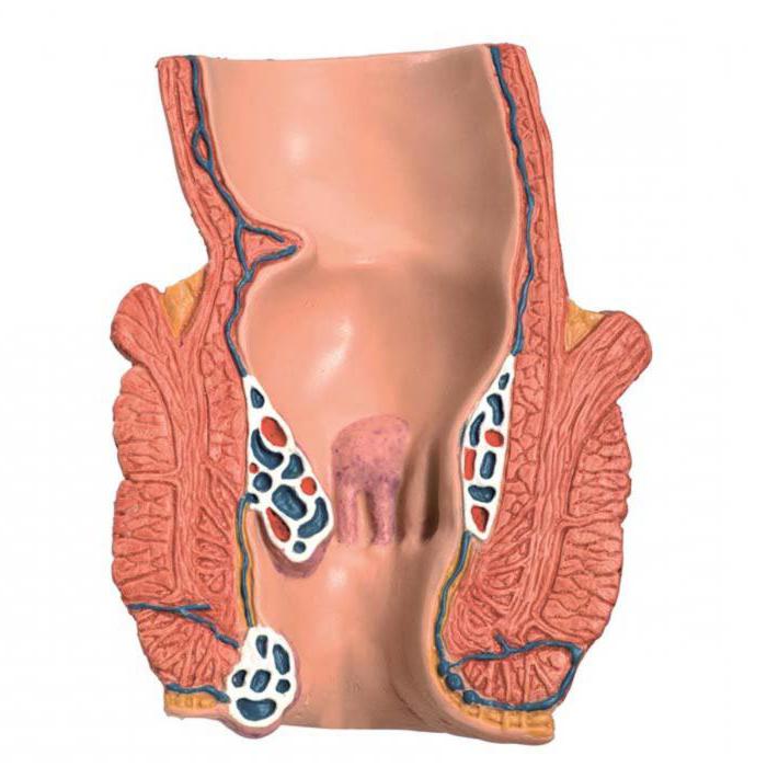 показания к оперативному лечению геморроя