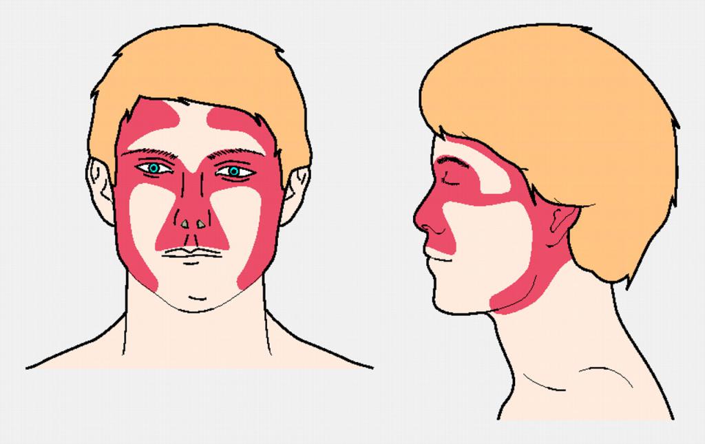 базалиома кожи лица лечение