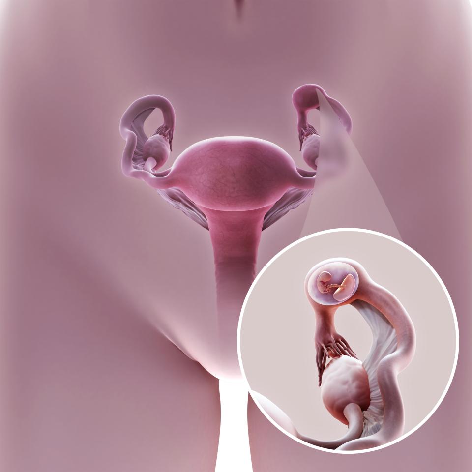 месячные при внематочной беременности на ранних сроках