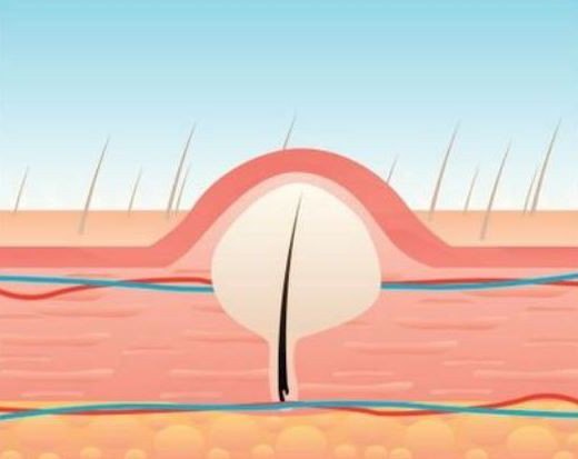 схема вросшего волоса