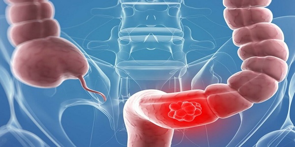 Первые симптомы рака кишечного тракта
