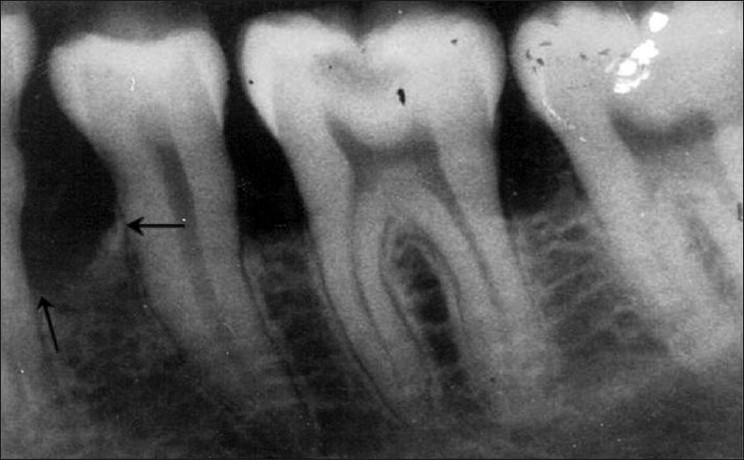 снимок поврежденных зубов