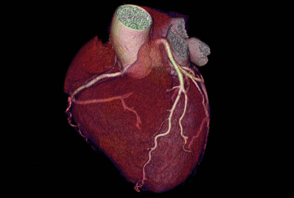 томография сердца
