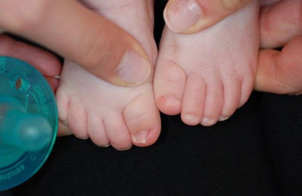 Грибок ногтей у детей симптомы