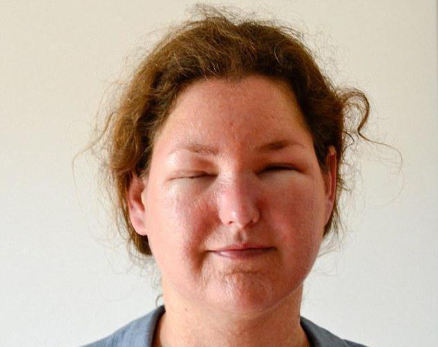 аллергия на солнце фото на лице