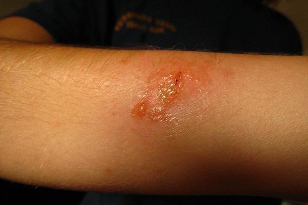 токсико аллергический дерматит фото у взрослых