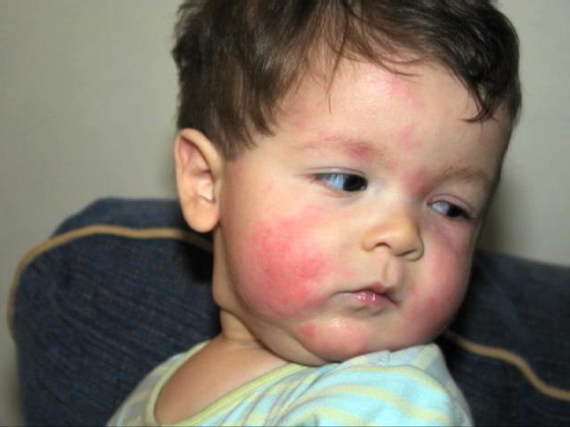 токсико аллергический дерматит у детей
