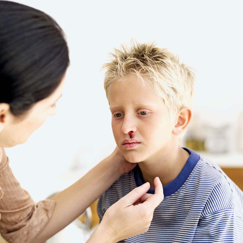 частые носовые кровотечения у детей причины