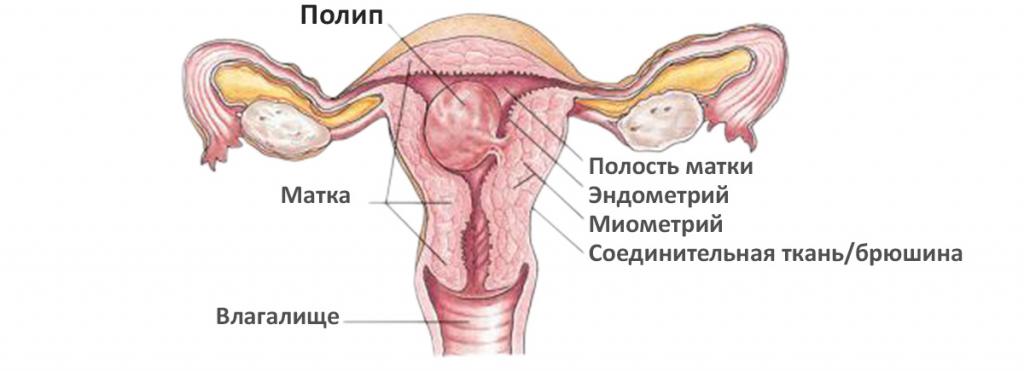 эндометрит матки лечение