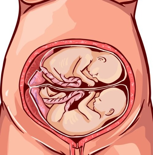 девушка беременна двойней