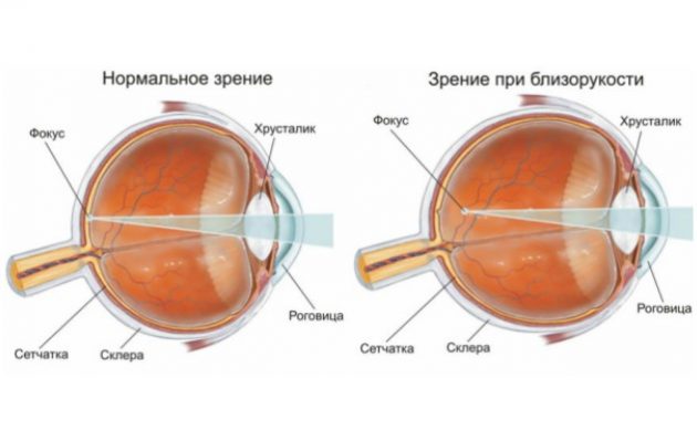 Состояние глазного яблока при миопии