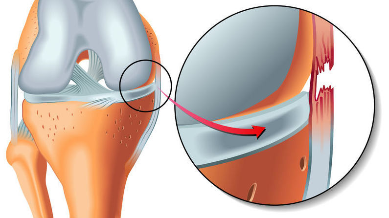 Повреждение связки
