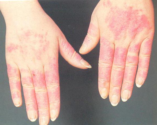 аллергия на холод на руках симптомы и лечение 
