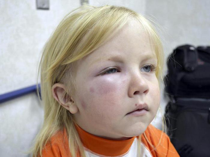 аллергия у ребенка психологические причины