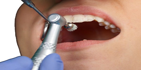 Профессиональное фторирование зубов