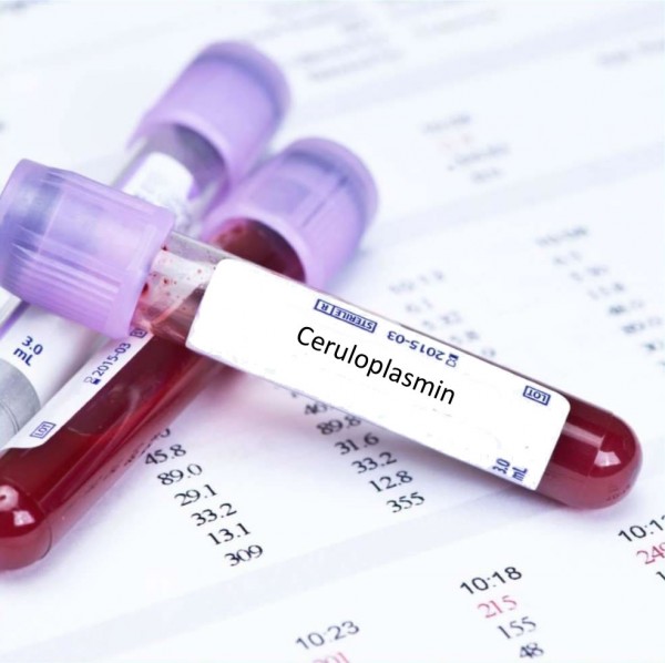 Анализ крови на церулоплазмин