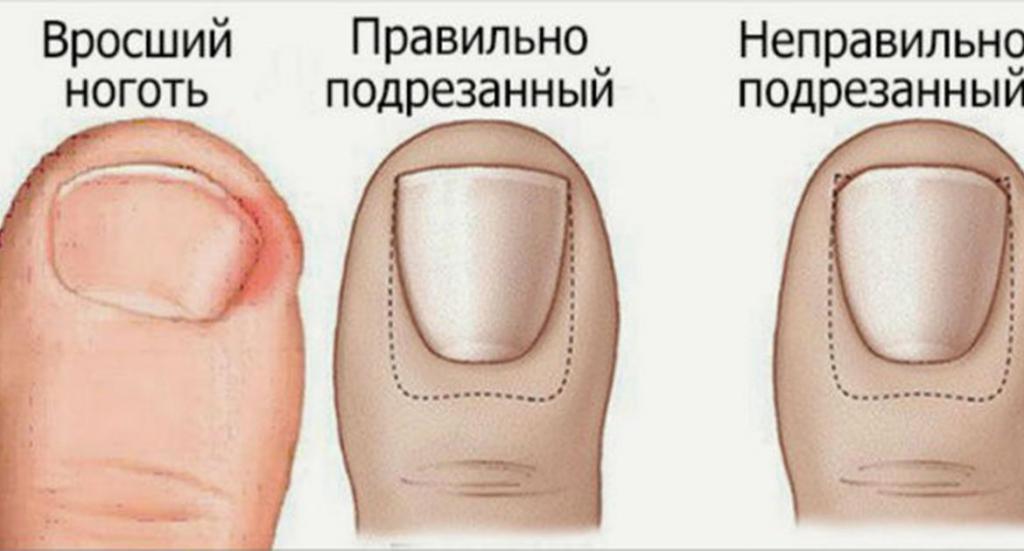 Удаление вросшего ногтя лазером в Москве: описание процедуры, обзор клиник, отзывы