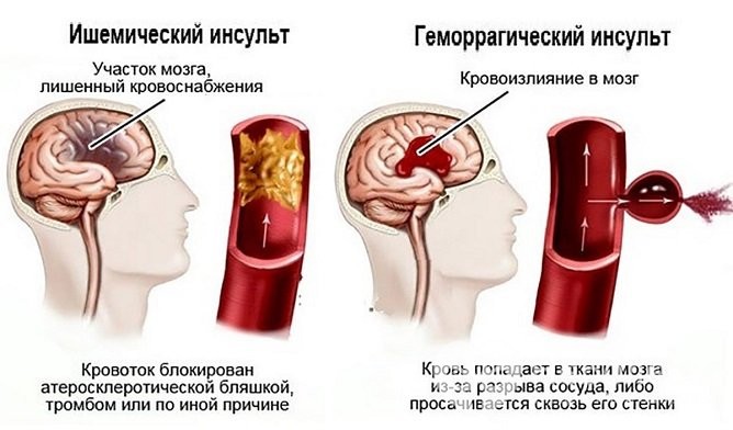 геморрагический инсульт