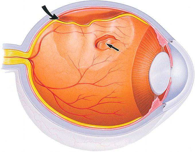 отслоение сетчатки глаза после операции 