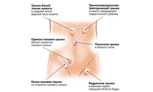 как выглядит послеоперационная грыжа на животе