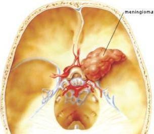 конвекситальная менингиома правой лобной области