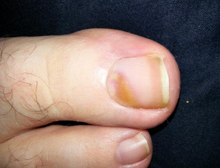 Меланома ногтя ноги