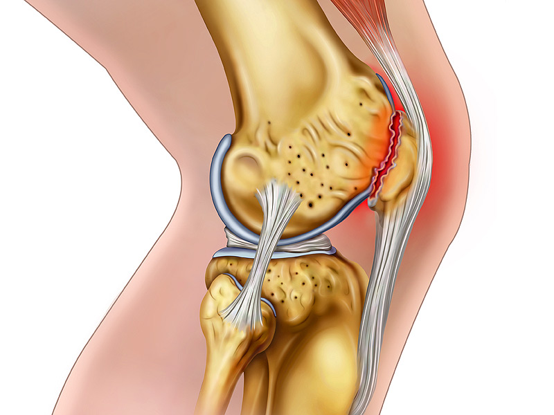 удаление мениска коленного сустава