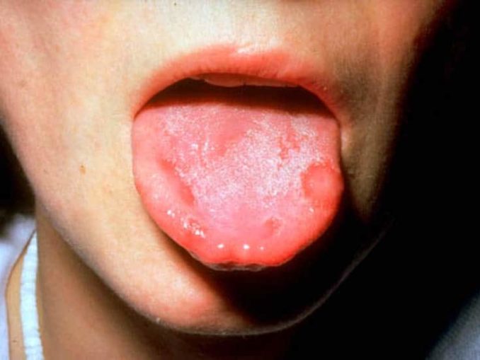 рак языка