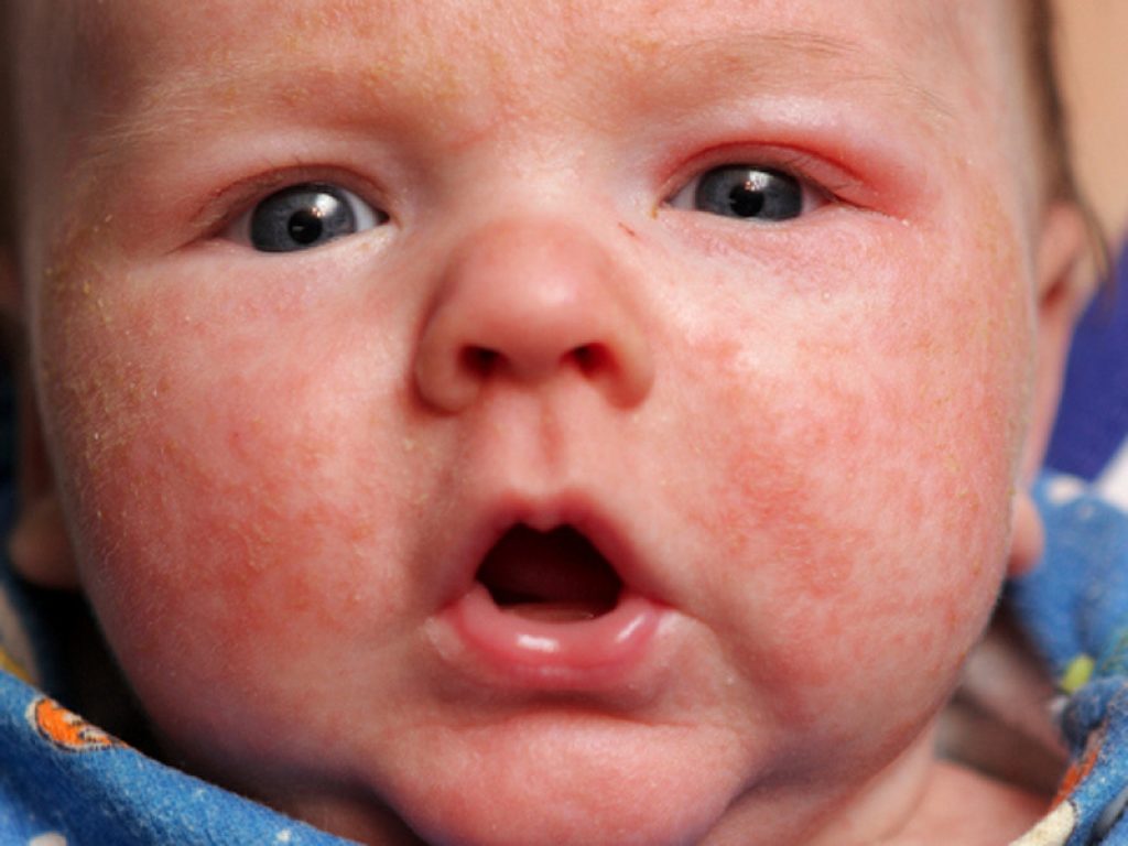 вылечит аллергический дерматит у ребенка