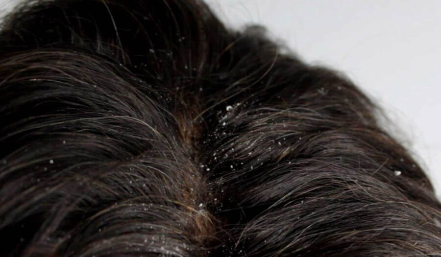 жирная себорея волосистой части головы