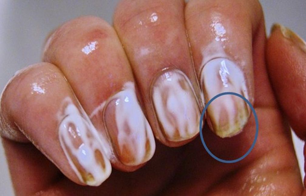 Лечение грибка ногтей мазями