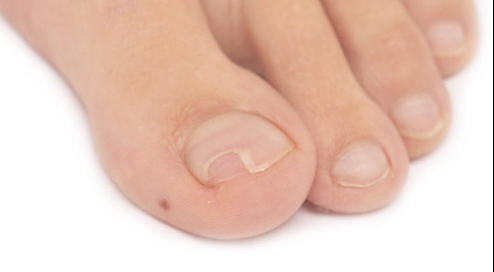 Эффективное народное средство лечения грибка ногтей отзывы