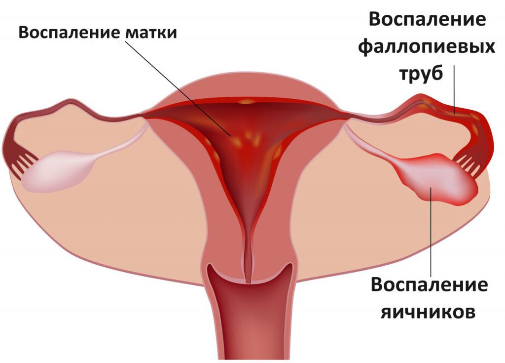 Лечение эндоцервицита шейки