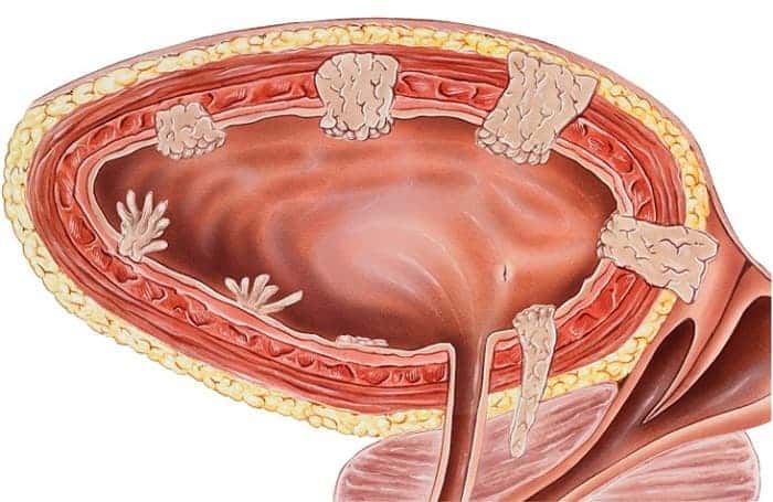 доброкачественная опухоль мочевого пузыря