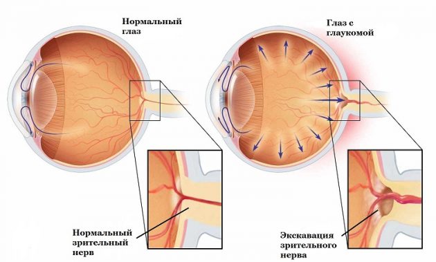 чем отличается глаукома от катаракты глаза