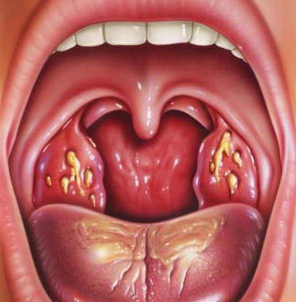 ангина мкб 10 классификация тонзиллита 