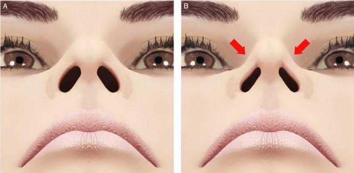 ринопластика коррекция кончика носа 