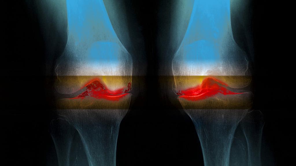 артрит коленного сустава причины