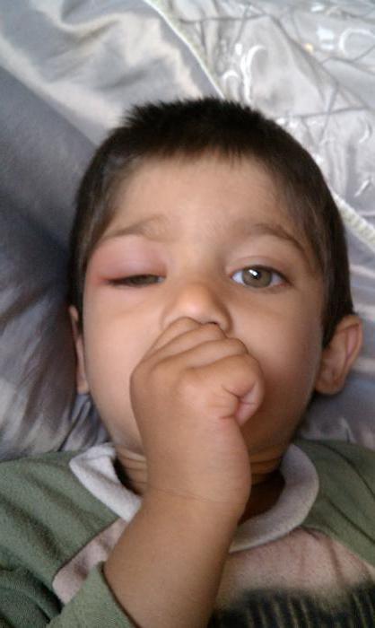 аллергия опухли глаза у ребенка что делать 