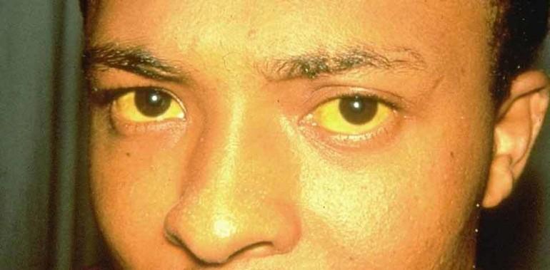 желтые склеры глаз