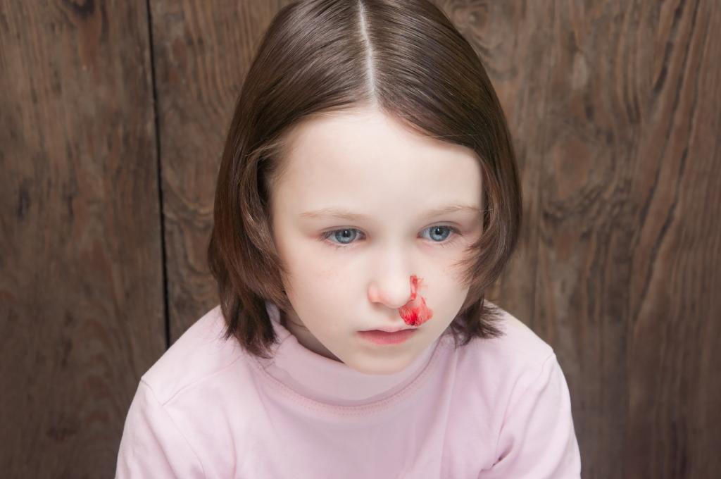 кровотечение из носа у ребенка