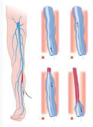 склерозирование вен на ногах отзывы