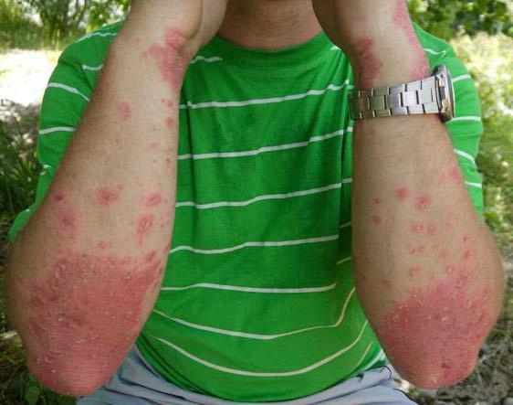 аллергия на солярий симптомы 