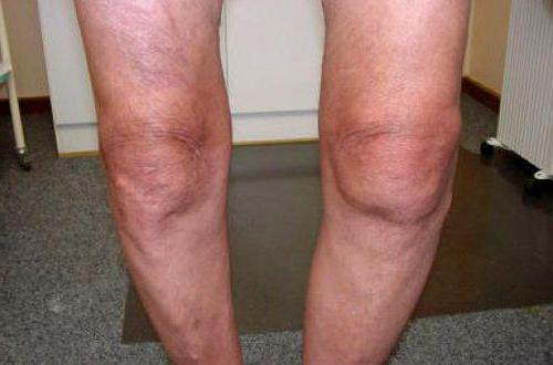 Код по МКБ-10: артроз коленного сустава